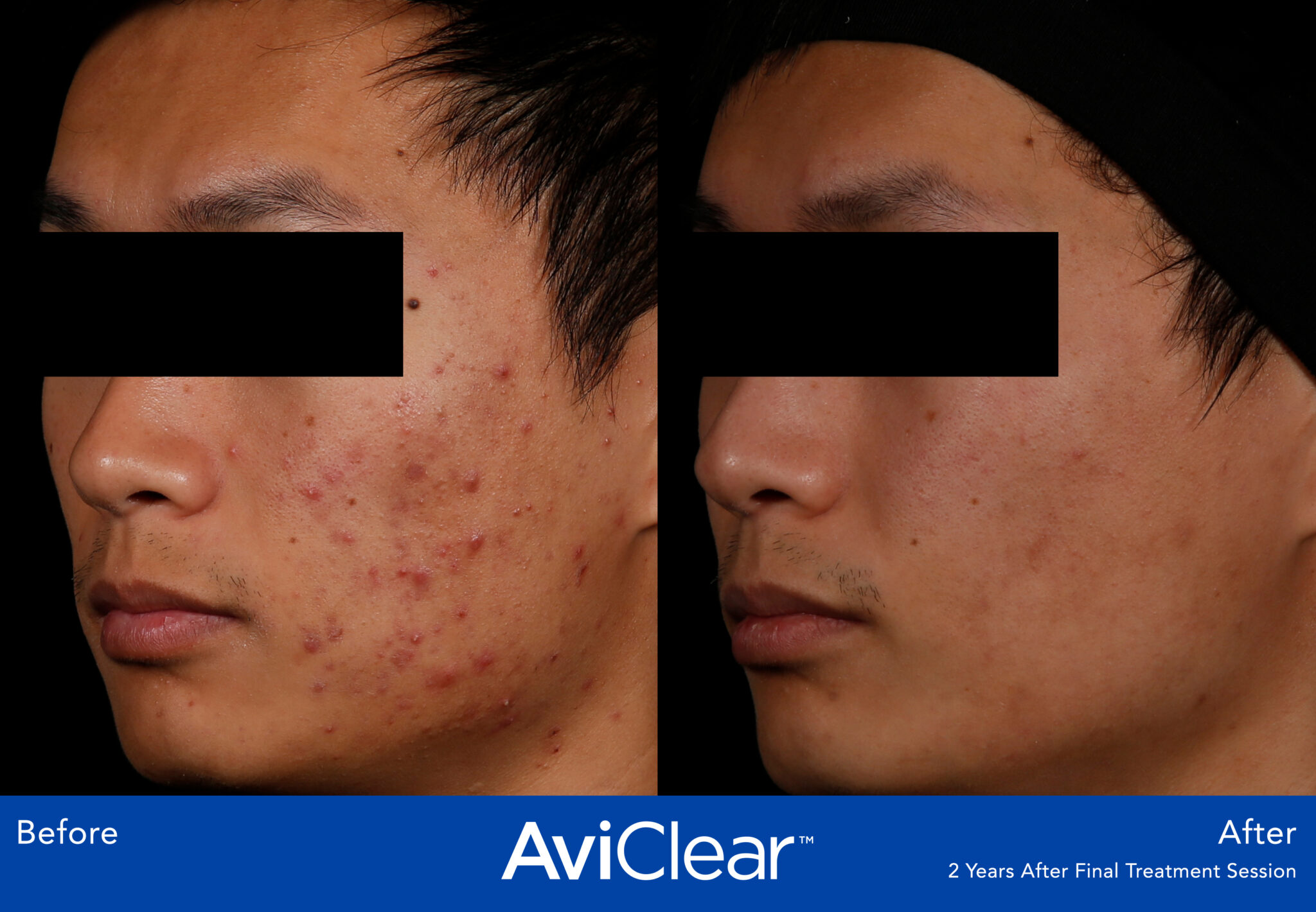 AviClear Treatment Before After Highland Park IL
