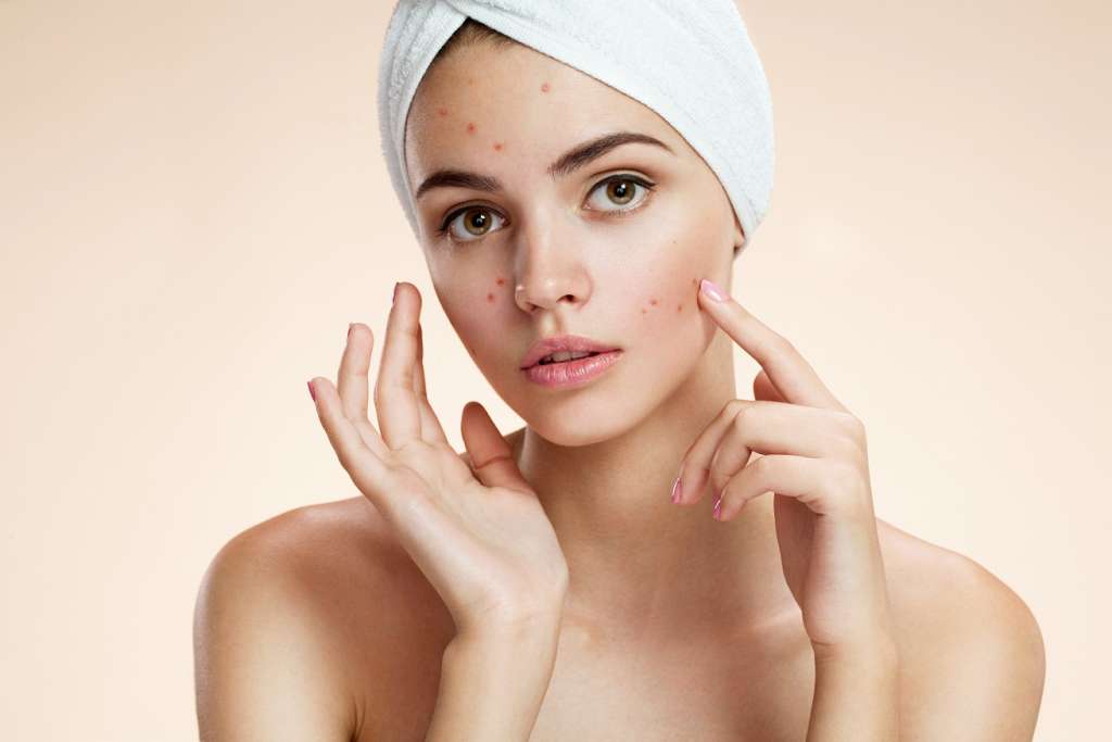 AviClear Treatment for Acne